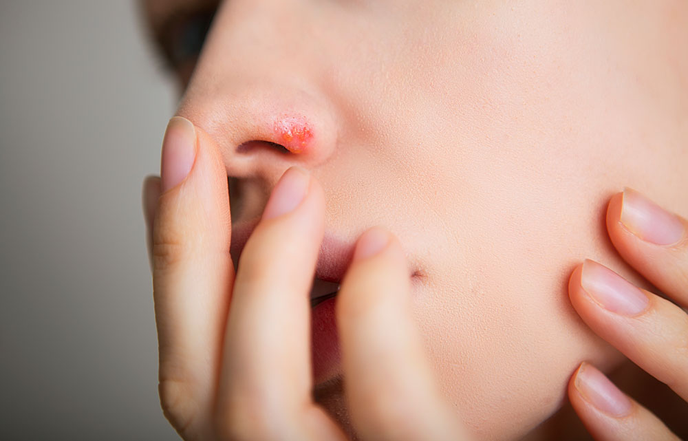 Fieberbläschen an der Nase einer Frau