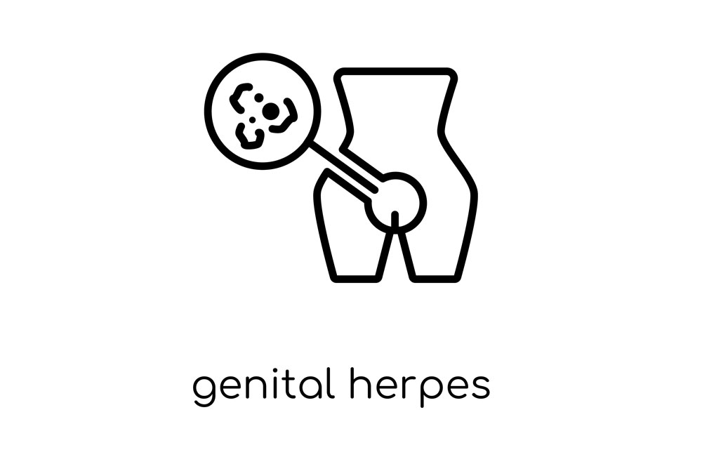 Abbildung: Herpes-Simplex-Virus am Unterleib (Herpes genitalis)
