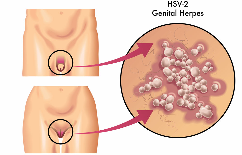 Abbildung: Genitalherpes (HSV-2) beim Mann und der Frau