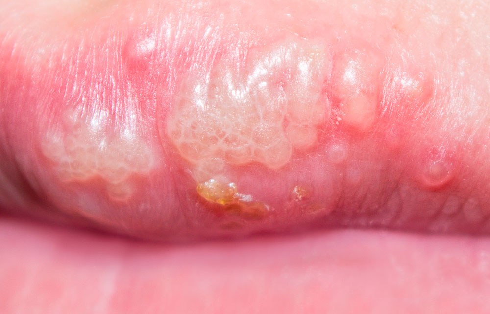 Nahaufnahme: Fieberbläschen an der Lippe (Herpes Labialis)